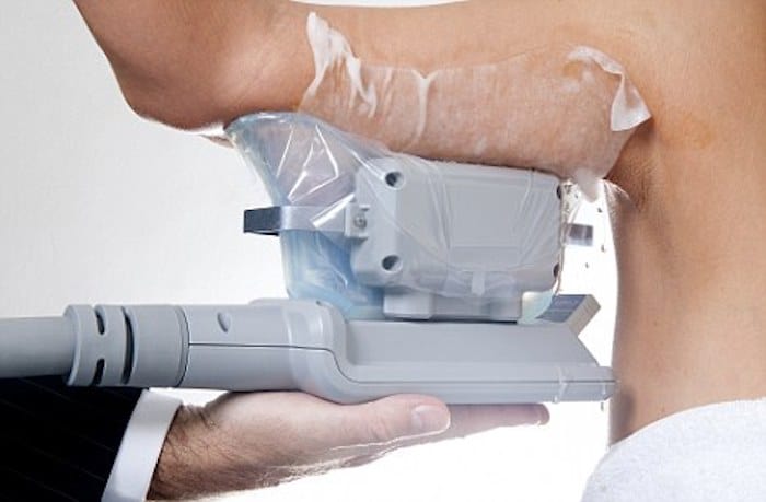 fat freezing arms Macclesfield