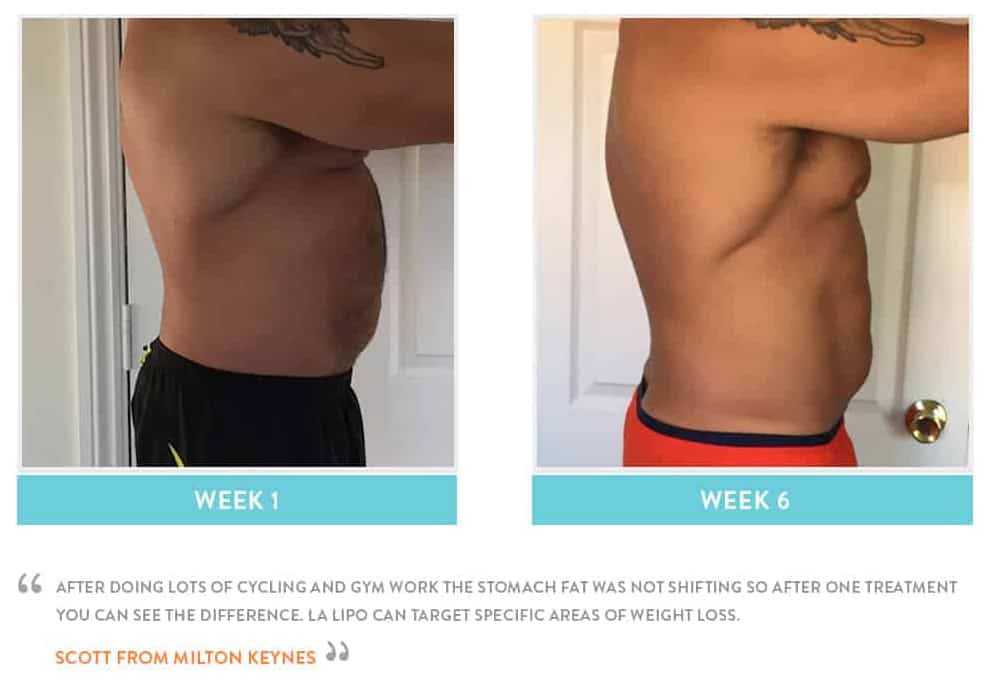 Before & After Stomach Fat Macclesfield