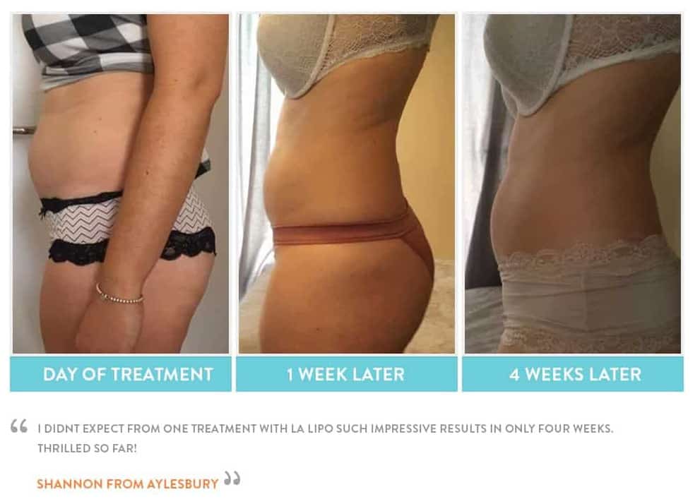 before, Cryolipolysis Macclesfield