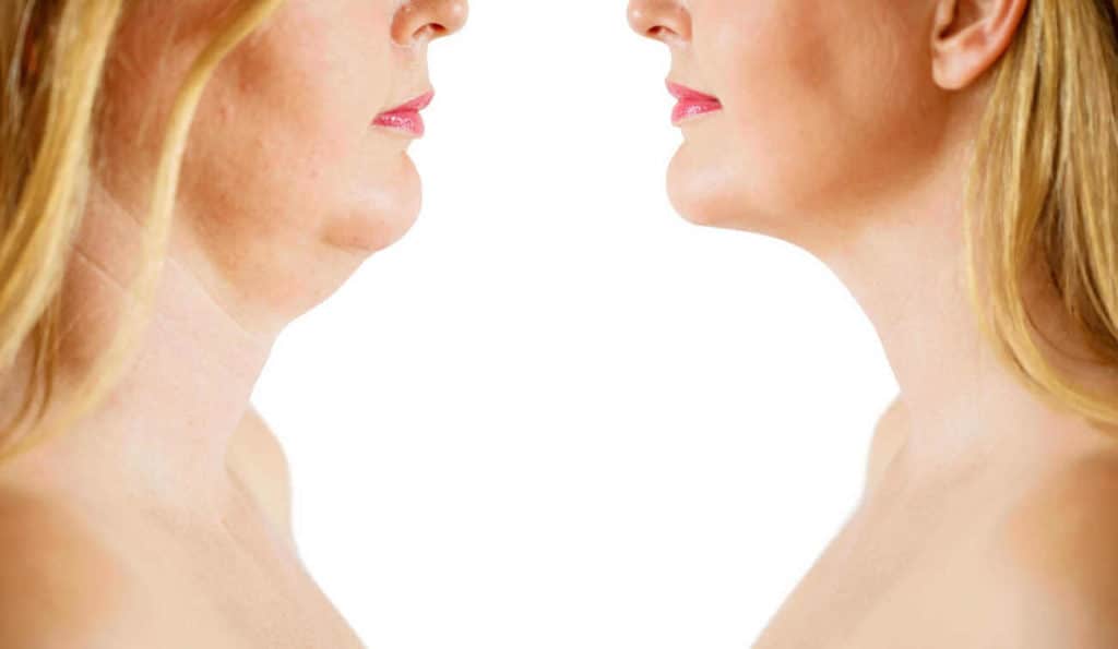Double Chin treatment Macclesfield before and after results