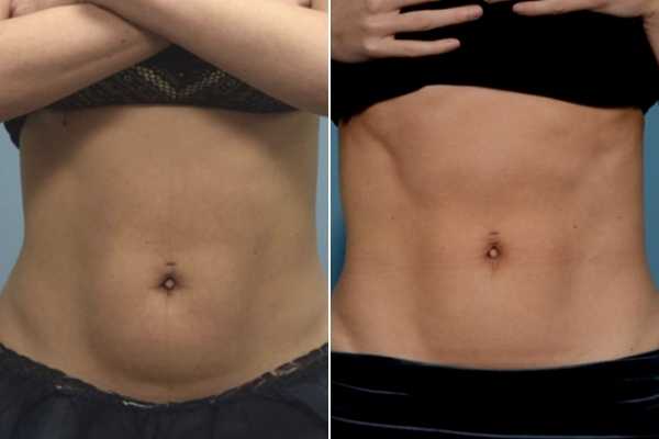 body sculpting FAQs Macclesfield
