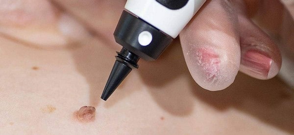 After Skin Tag Removal Macclesfield