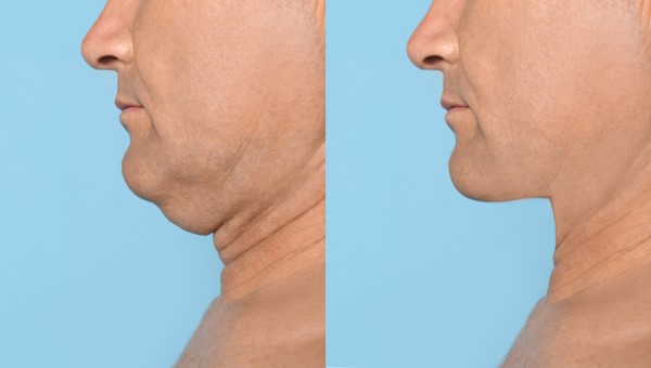 Which Non-Surgical Treatments Work Best for Jowls and Loose Skin Macclesfield?