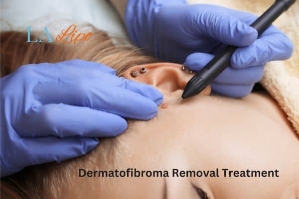 Dermatofibroma Removal Treatment Macclesfield