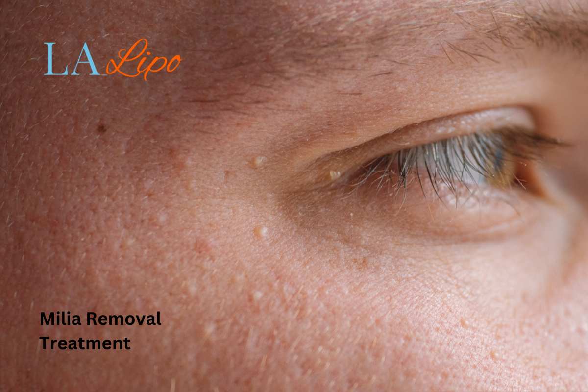 Cryopen Milia Removal: Is It the Easiest and Safest Option Macclesfield?