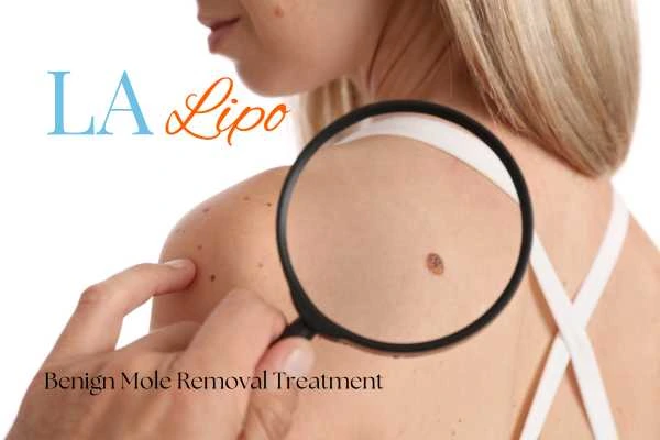 Why getting moles removed Macclesfield can boost your confidence!