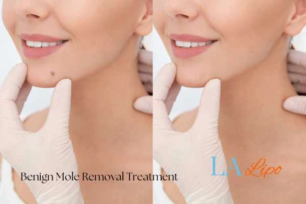woman's before and after mole removal Macclesfield results