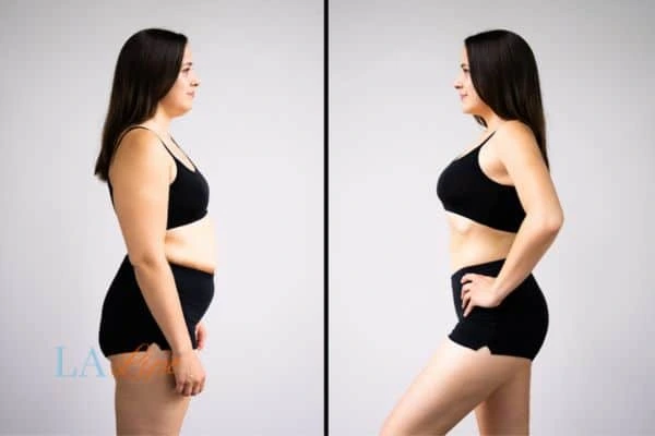 image of woman before and after results of LA-EMS Body Sculpting Macclesfield to help treat Diastasis recti