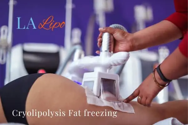 women getting fat freezing Macclesfield