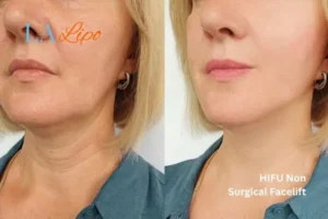 hi-fu for wrinkles Macclesfield before and after results