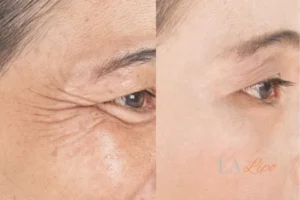 Before and after results of woman - HI-fu wrinkles reduction treatment Macclesfield