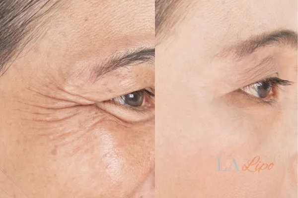 Before and after results of woman - HI-fu wrinkles reduction treatment Macclesfield