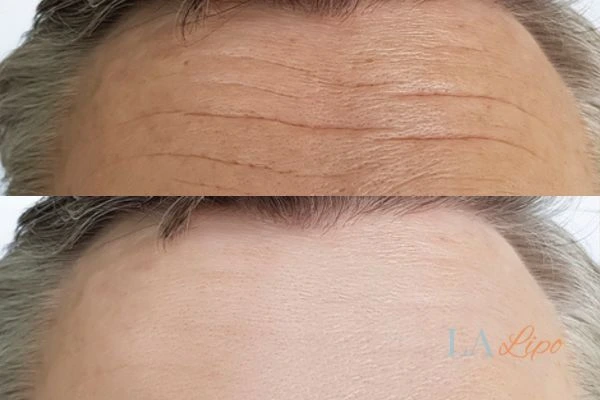 results of HIFU Macclesfield on mans forehead to help reduce lines and wrinkles