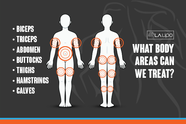 Graphic to show areas you can have LA-EMS Body Sculpting Macclesfield treatment.