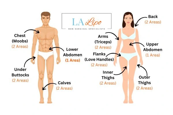 LA LIPO Cryolipolysis Areas Macclesfield