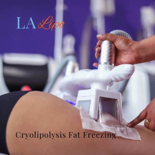 fat freezing - Cryolipolysis Macclesfield