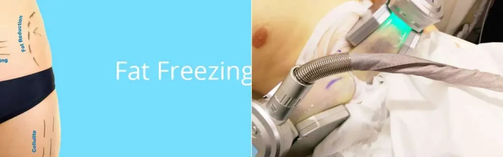 multi areas of a persons body having coolsculpting Macclesfield treatment