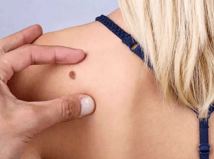 woman having mole removal Macclesfield consultation before treatment.