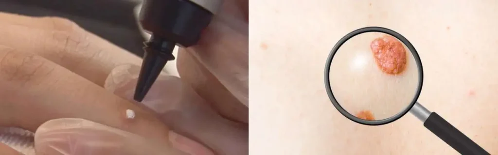 Cryopen for mole removal Macclesfield - speak to our team today!