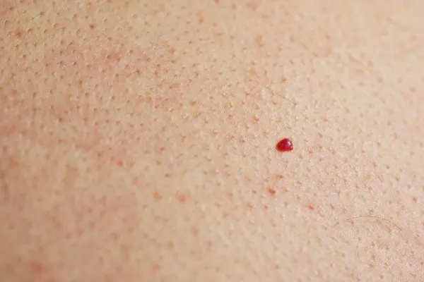 close up of a cherry angioma Macclesfield