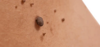 image of a skin tag Macclesfield