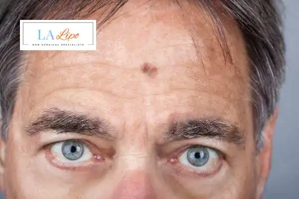 Solar Lentigo Removal Macclesfield image of man with mark on his forehead