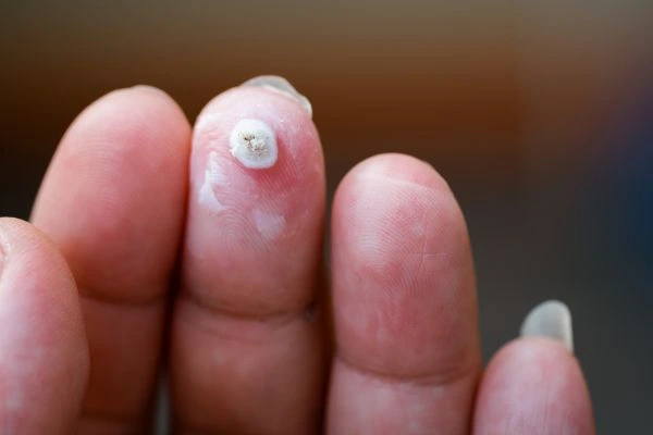 wart on person finger - cryotherapy to treat from LA LIPO Macclesfield