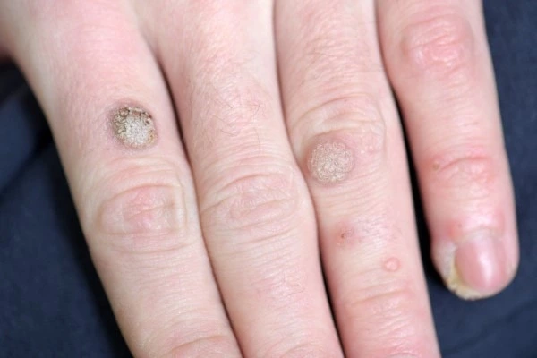 photo of warts on person hand - see wart removal Macclesfield from LA LIPO
