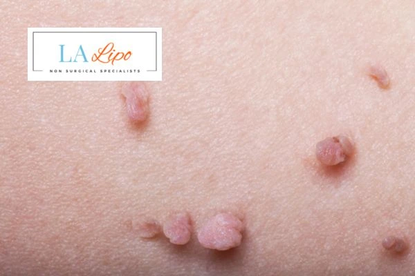 Does cryopen skin tag removal Macclesfield hurt? Find out now call our team today!