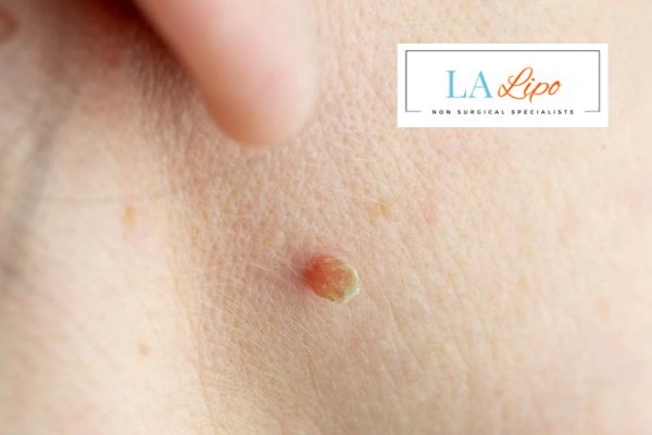 Book skin tag removal Macclesfield today speak to our team now!