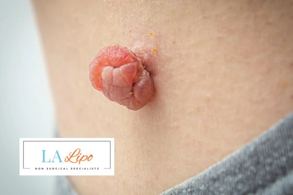 Interested in skin tag removal Macclesfield? Concerned about the pain? Find out more today!