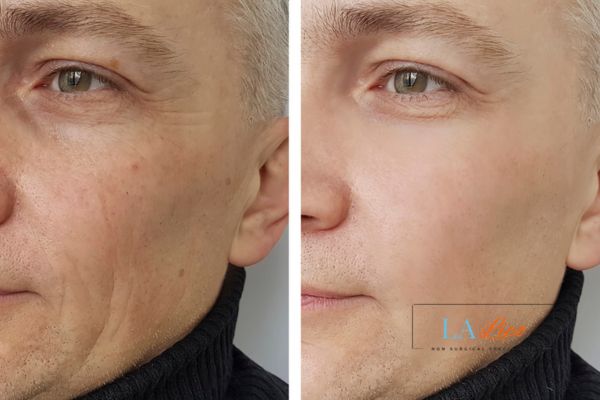 See the amazing results of Morpheus8 Treatment Macclesfield!