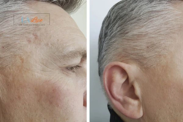 Mens Before & After Morpheus 8 Results Macclesfield