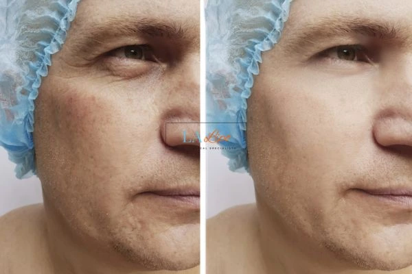 Before and after Morpheus 8 Results Macclesfield