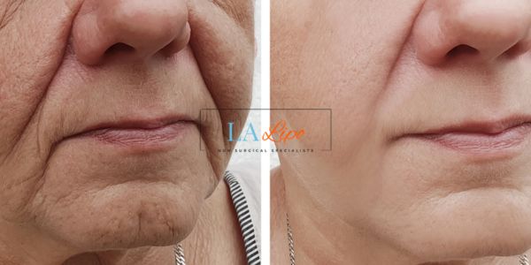 Older lady deeper wrinkle reduction - LA LIPO Morpheus 8 Results Macclesfield