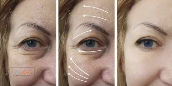 Amazing eye lift Morpheus 8 results Macclesfield