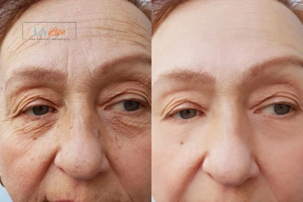The powerful benefits of Morpheus8 Treatment Macclesfield - Call Our team today!