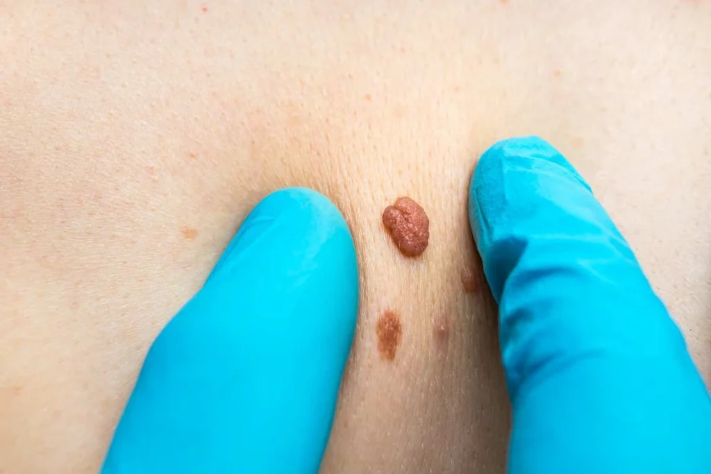 LA LIPO Cryopen Lesion Removal Prices Macclesfield