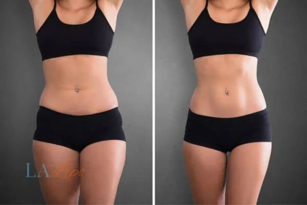 before and after results of non-surgical treatment to help a woman's body image and mental health Macclesfield