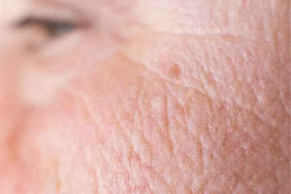 close up picture of a woman's face showing an age spot Macclesfield