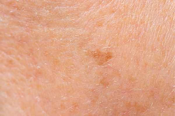 close up picture of age spots Macclesfield