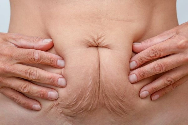 Image of a woman's stomach with loose skin - example of skin tightening Macclesfield options