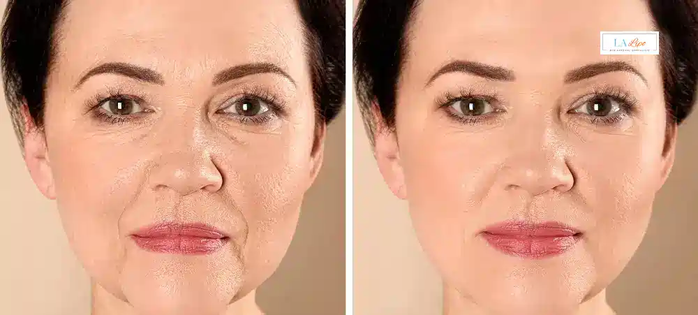 How Long Does It Take to See Results and How Long Do They Last Macclesfield?